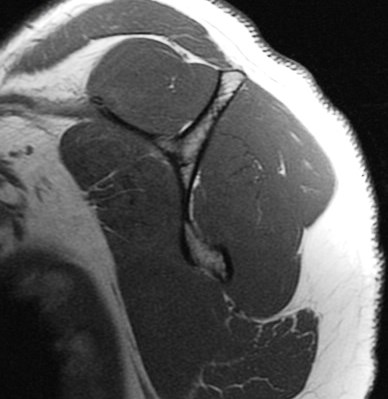 Figure 5 for case scapular fracture and supraspinatus and subscapularis muscle strain ( RID1860 ) ( RID1870 )